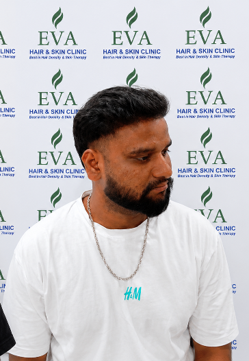 After hair transplant